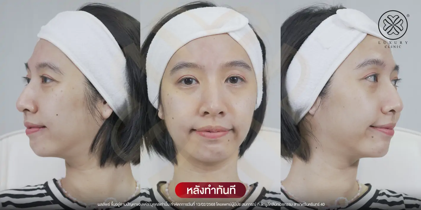 รักษาฝ้าหนา