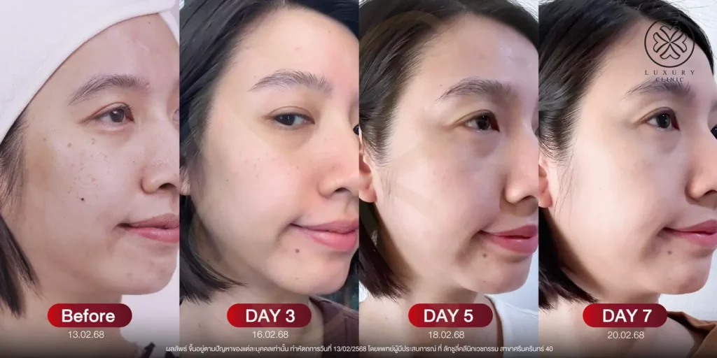 อัปเดตผิวหน้า 7 วัน (After)