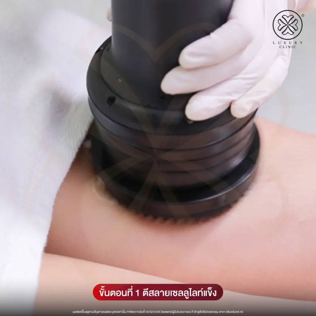 แก้ปัญหาขาเบียดด้วยประจุ LegDEF