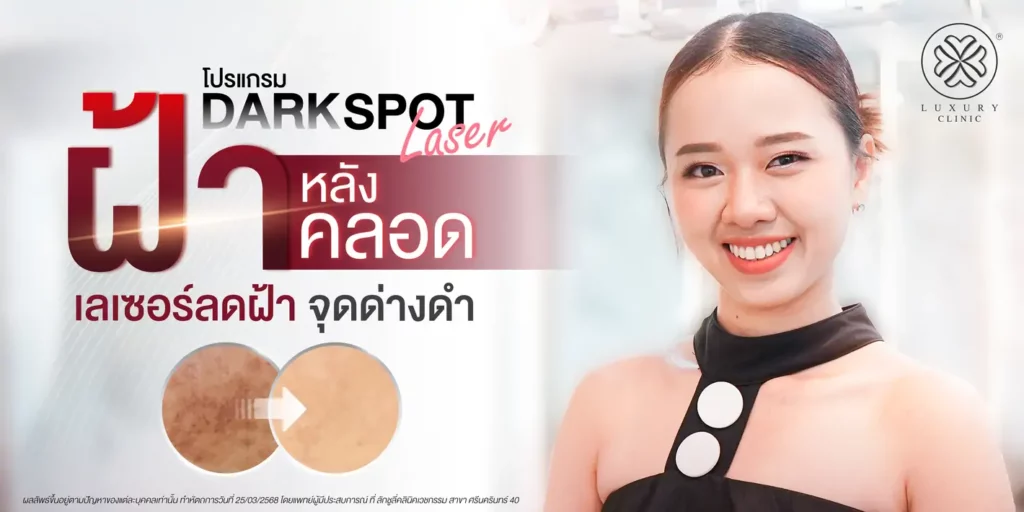 dark spot รักษาฝ้า