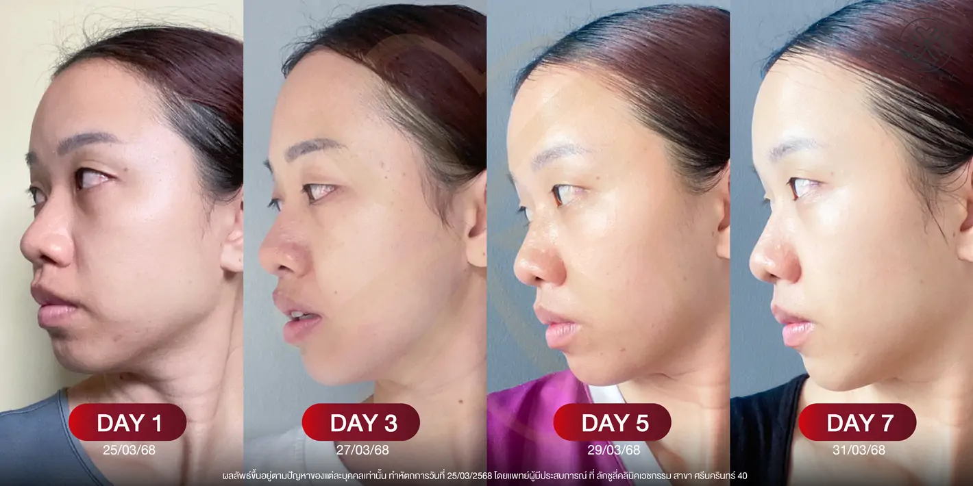 หลังทำ 7 วัน (After)