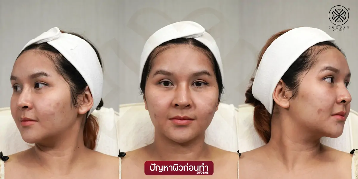 ปัญหาผิวก่อนทำ (Before)