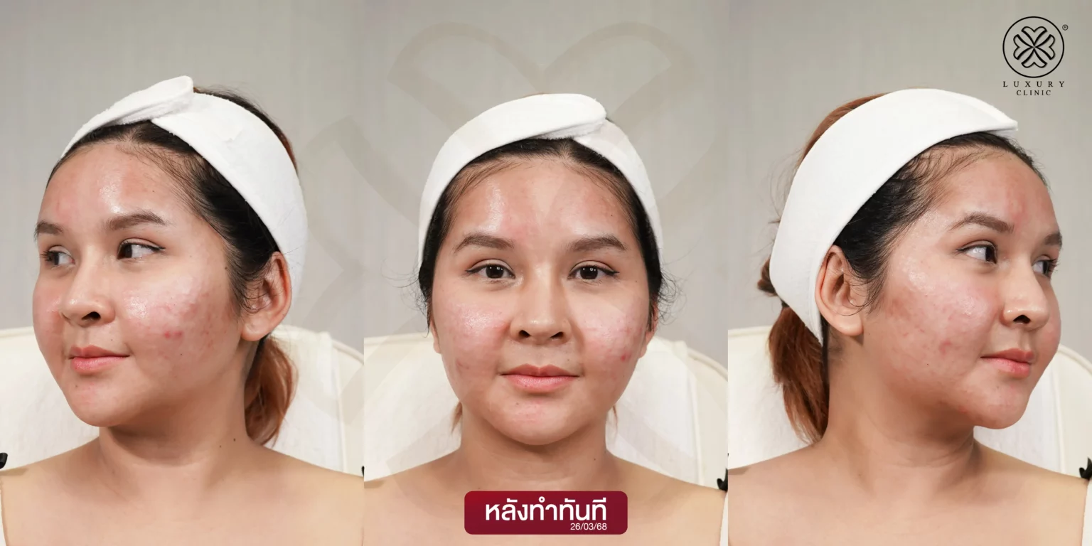 หลังทำทันที