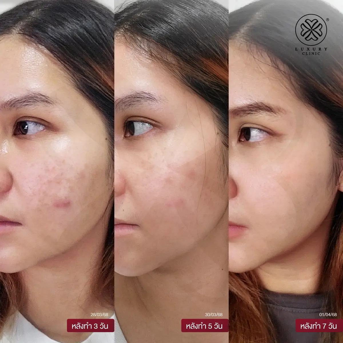 หลังทำ 7 วัน (After)