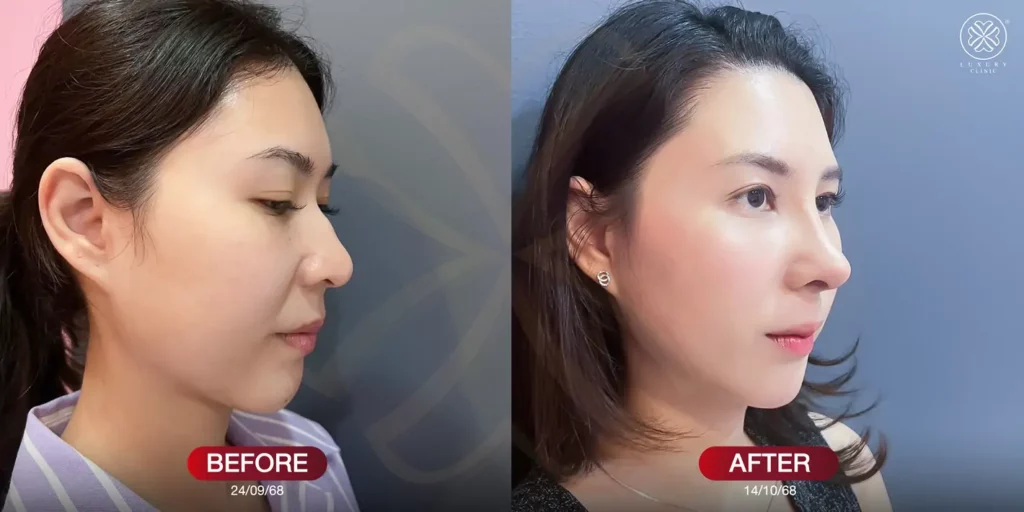 before-after