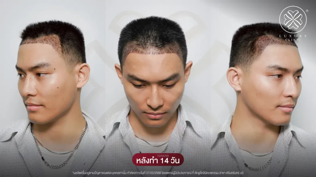 หลังทำ 14 วัน