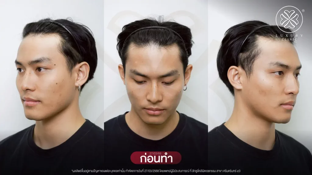 ก่อนทำ ปลูกผม