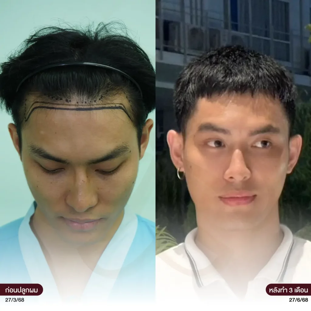 ก่อน-หลังปลูกผม 1 เดือน