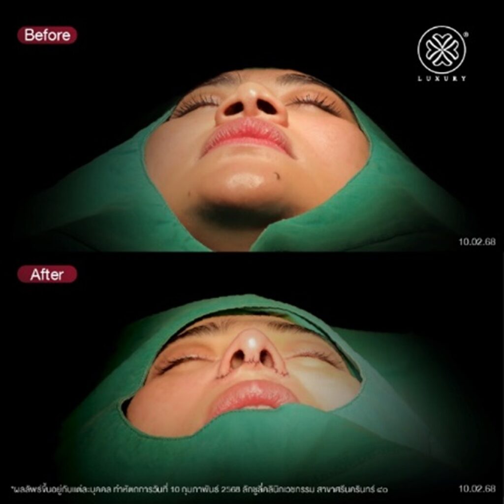 before - after