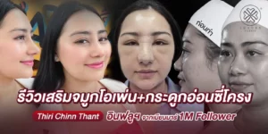 รีวิวเสริมจมูกโอเพ่นกระดูกอ่อนซี่โครง Thiri Chinn Thant อินฟลูเอนเซอร์จากเมียนมาร์ 1M Follower