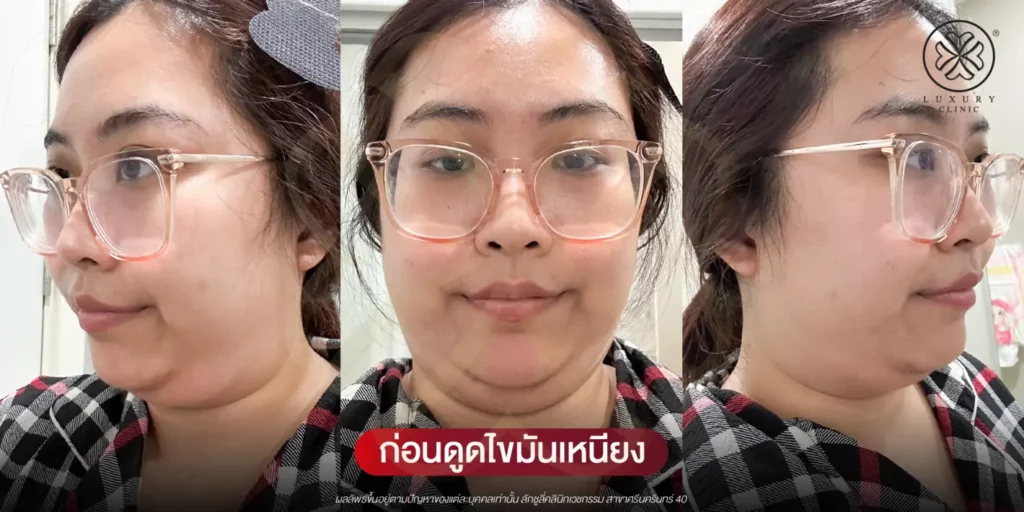 ก่อนดูดไขมันเหนียง