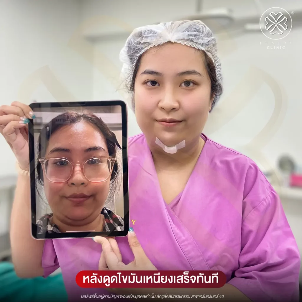 หลังดูดไขมันเหนียงทันที