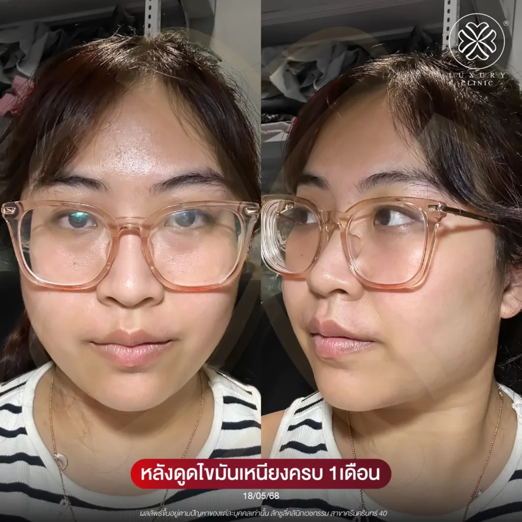 หลังดูดไขมันเหนียง 1 เดือน
