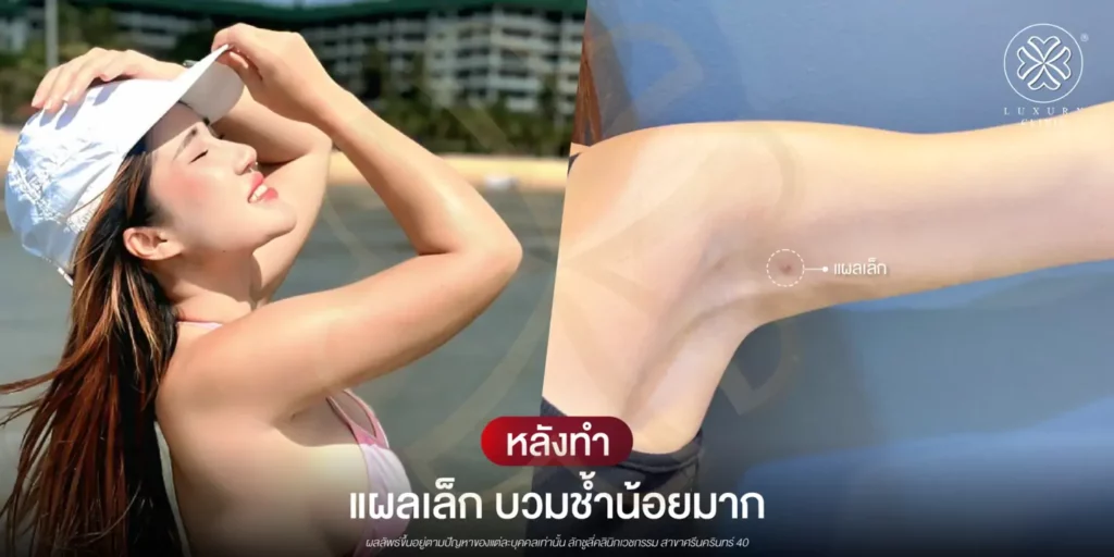 หลังทำ แผลเล็ก บวมช้ำน้อยมาก