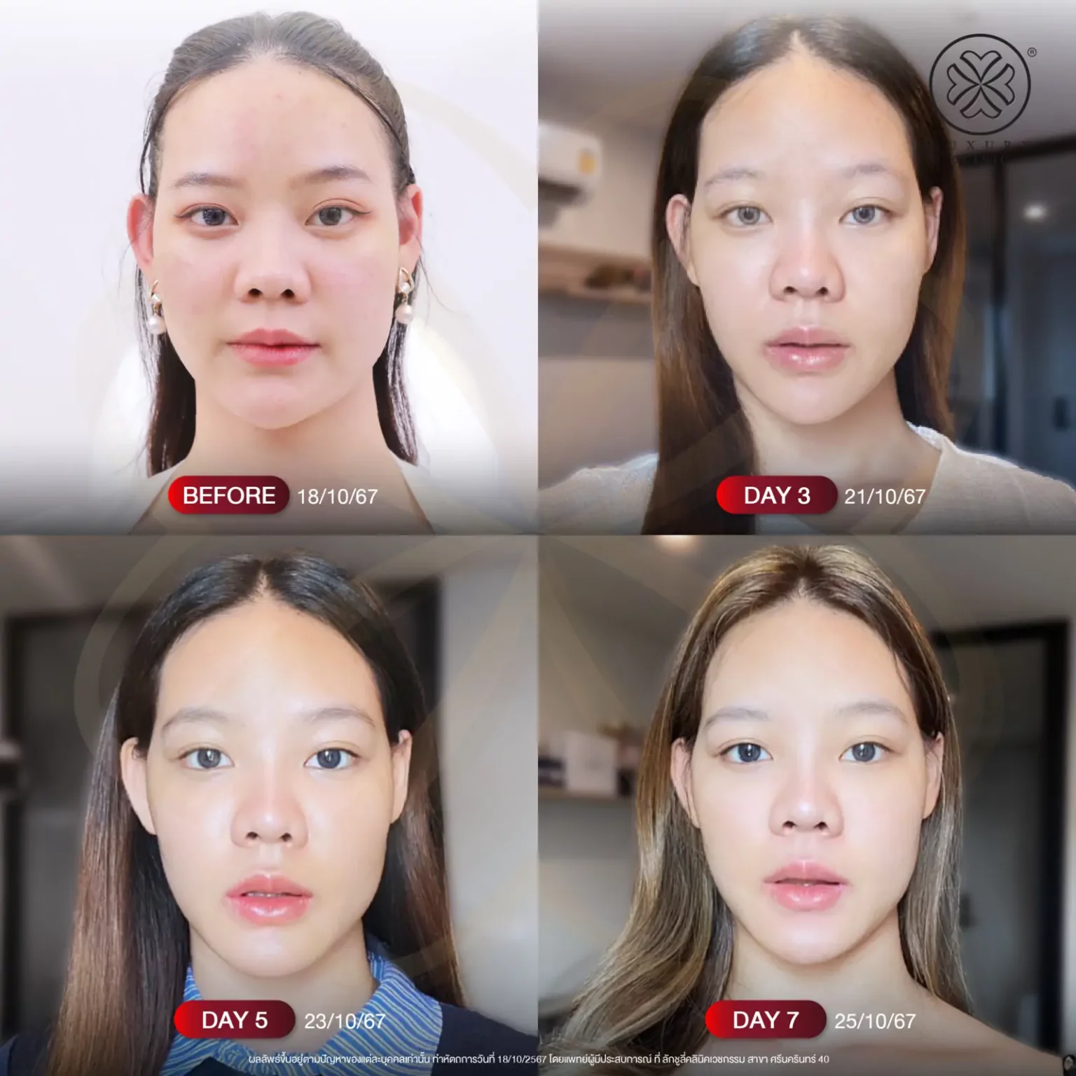 รีวิว media cell 3-7 วัน ปัญหาฝ้า จุดด่างดำ luxury clinic