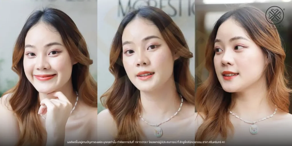 ผลลัพธ์การทำ media cell ปัญหาฝ้า จุดด่างดำ luxury clinic
