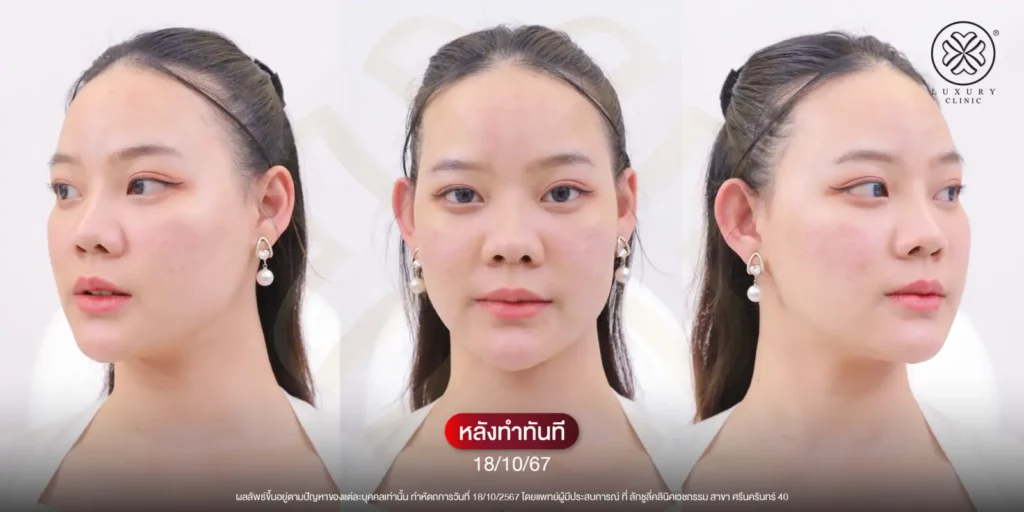 หลังทำทันที media cell ปัญหาฝ้า จุดด่างดำ luxury clinic