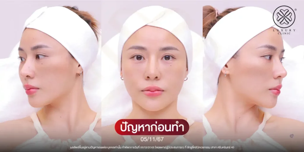 ปัญหาผิวก่อนทำ (Before)