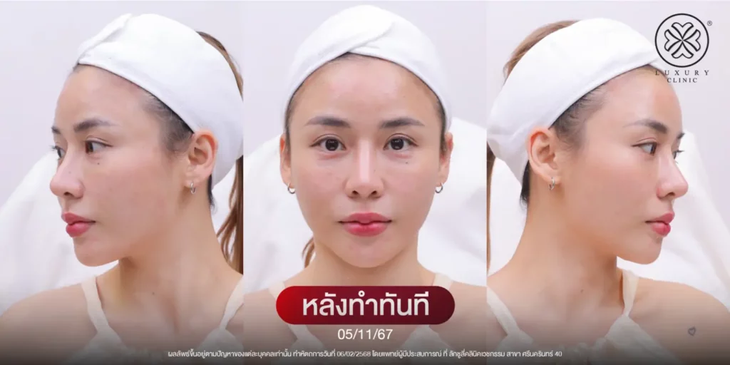 หลังทำทันที
