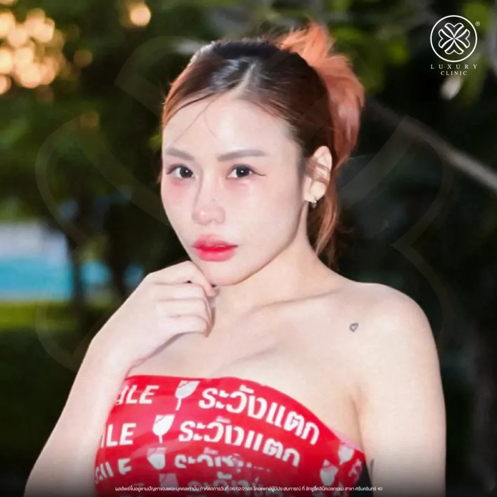 อัปเดตผิวหน้าหลังทำ (After)