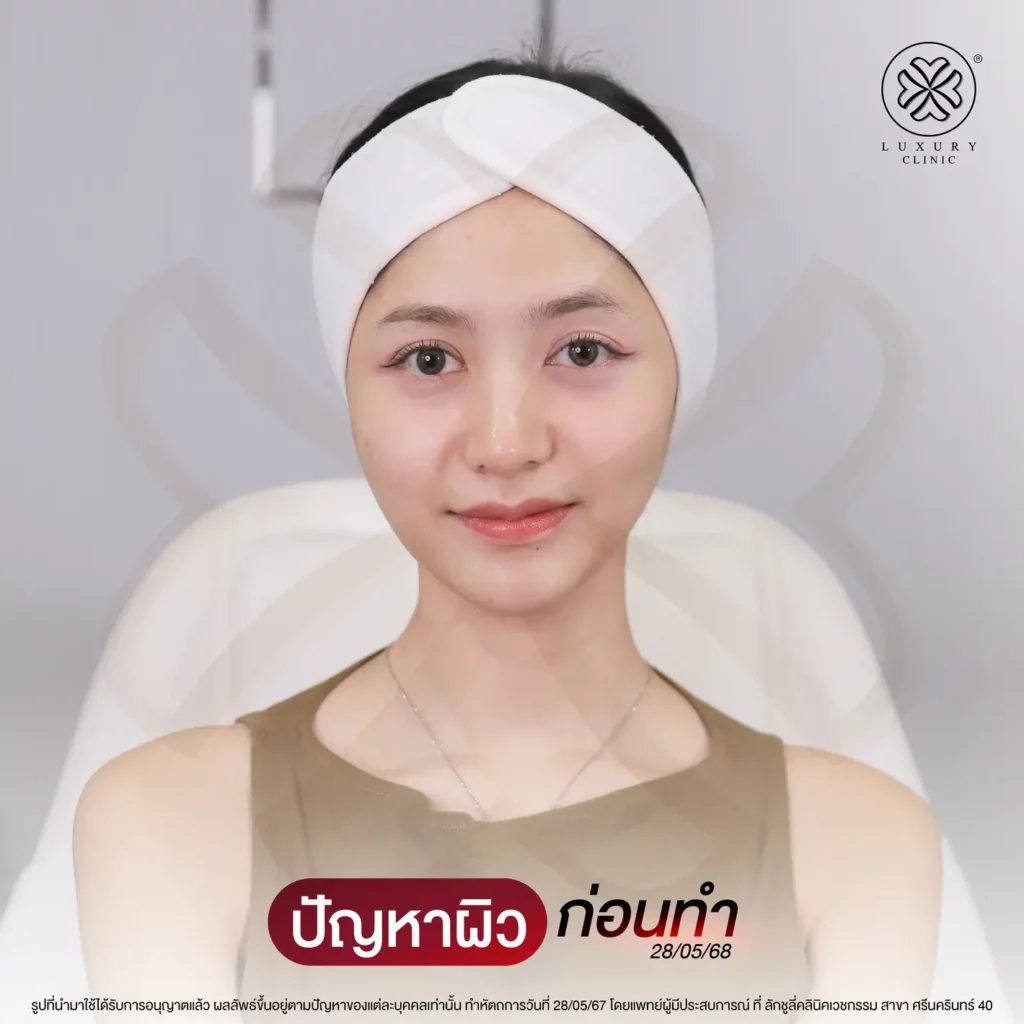 ปัญหาผิวหน้ากวนใจ (Bofore)